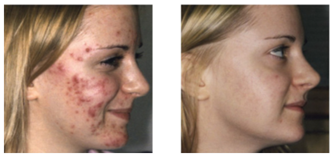 Bristol's Best Acne Clinic